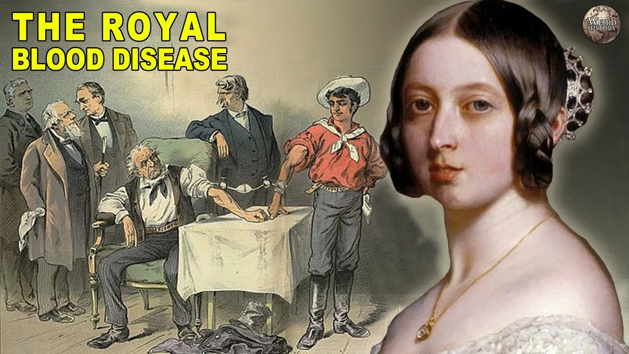 The History of Hemophilia: From Royal Disease to Modern Management